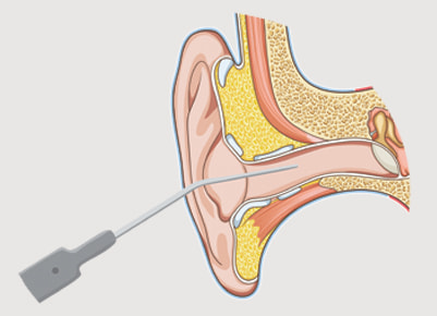 ear microsuction